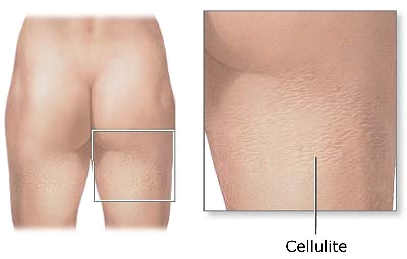 cellulite