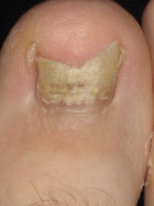 toenail fungus