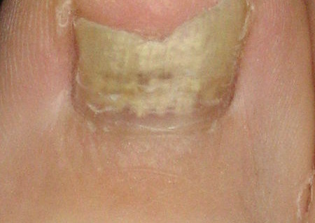 toenail fungus